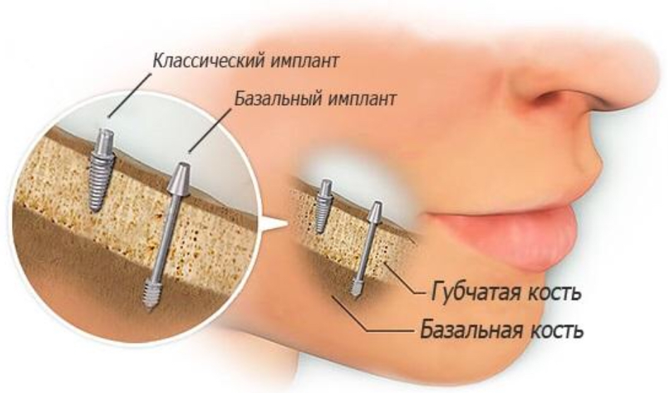 Базальная имплантация