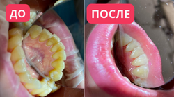 Профессиональная гигиена полости рта