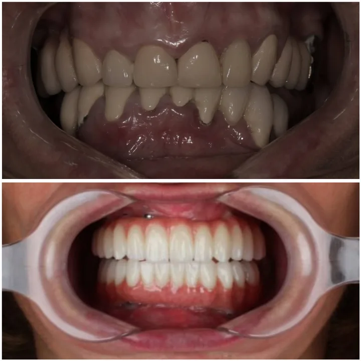 Протезирование до и после, кейс 3 — клиника White